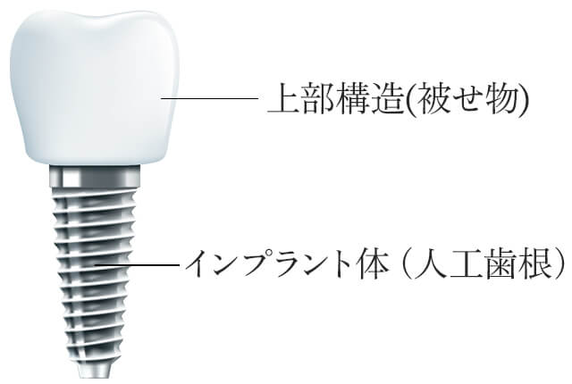インプラントのイラスト